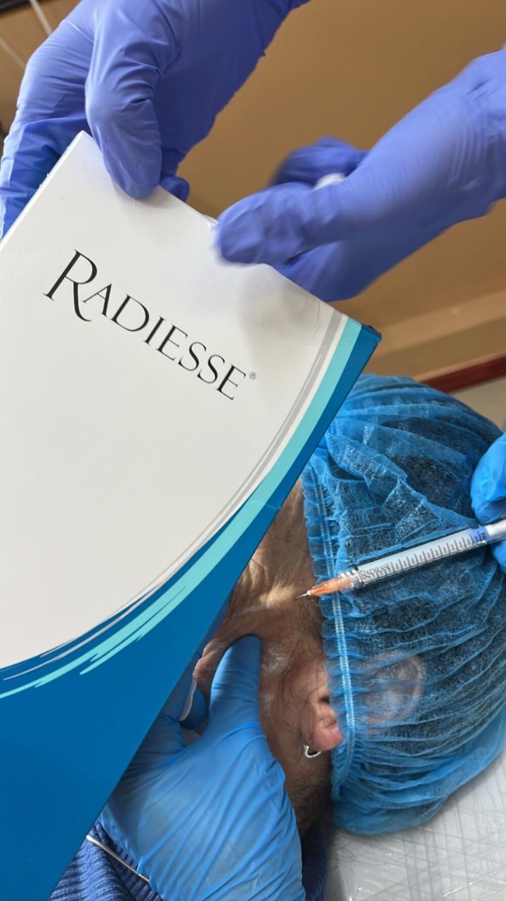 Aplicación de bioestimulador Radiesse en la clínica