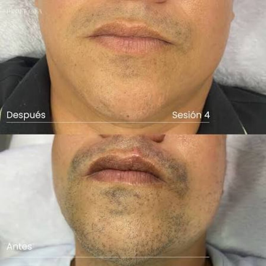Antes y después de depilación láser en barba y cuello, cuarta sesión