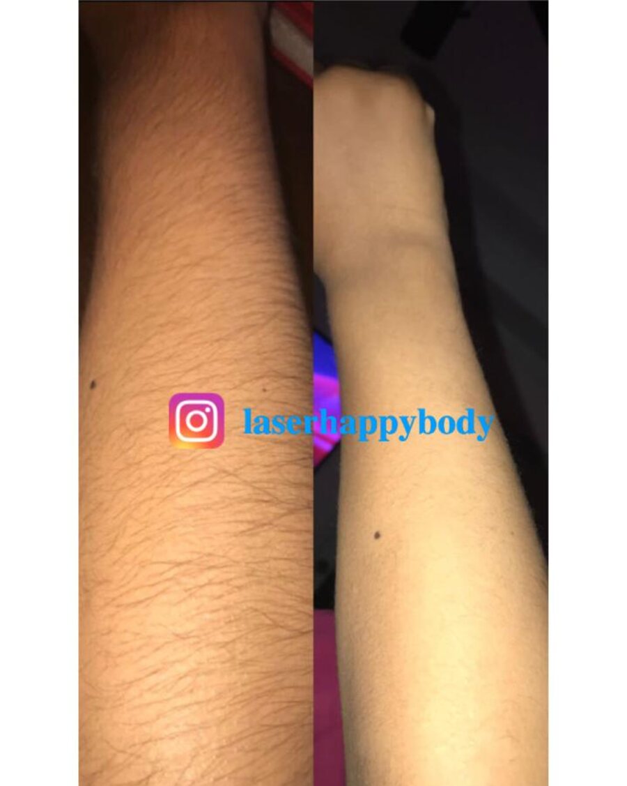 Antes y después de depilación láser en antebrazo