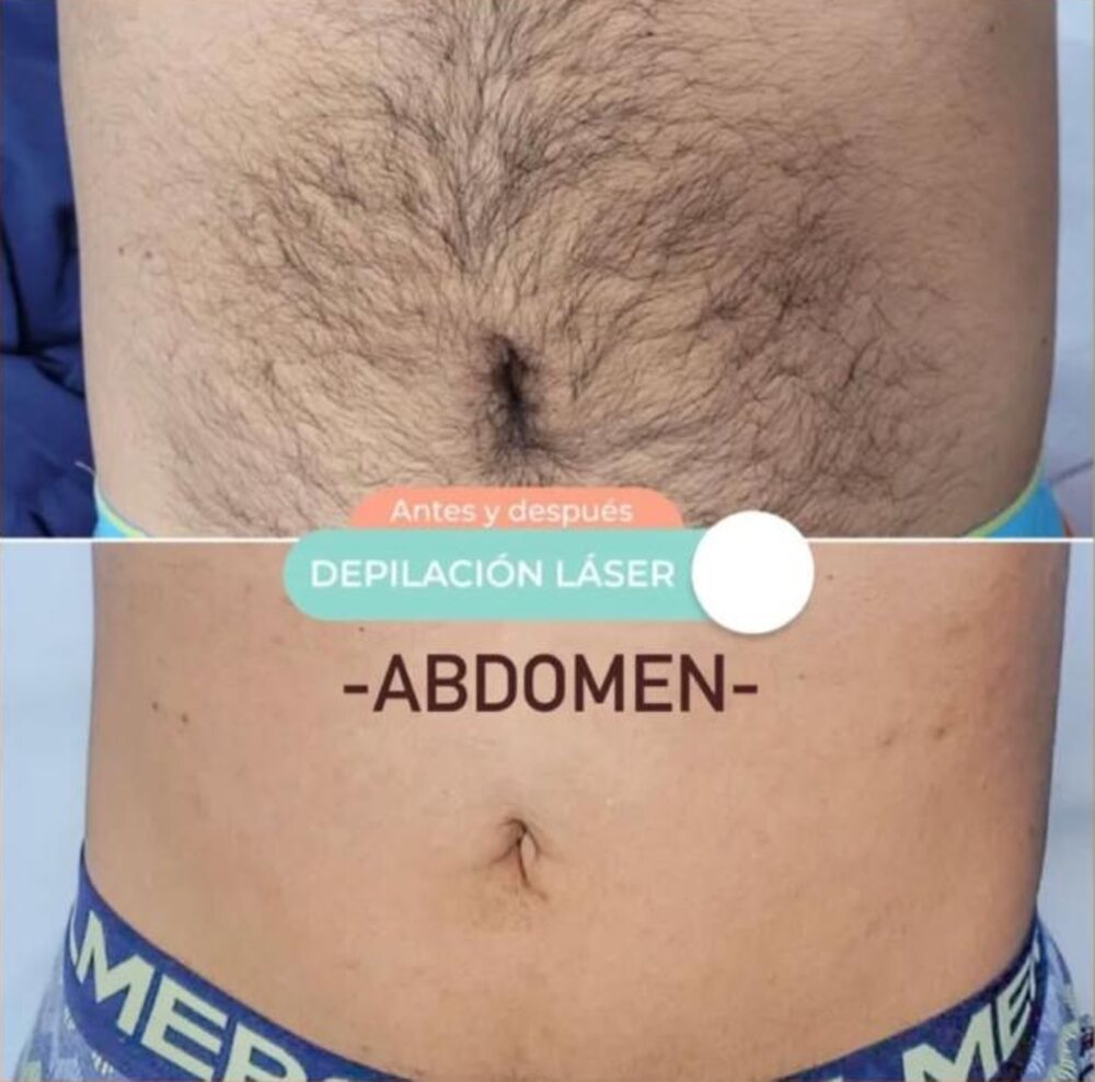 Antes y después de depilación láser en abdomen