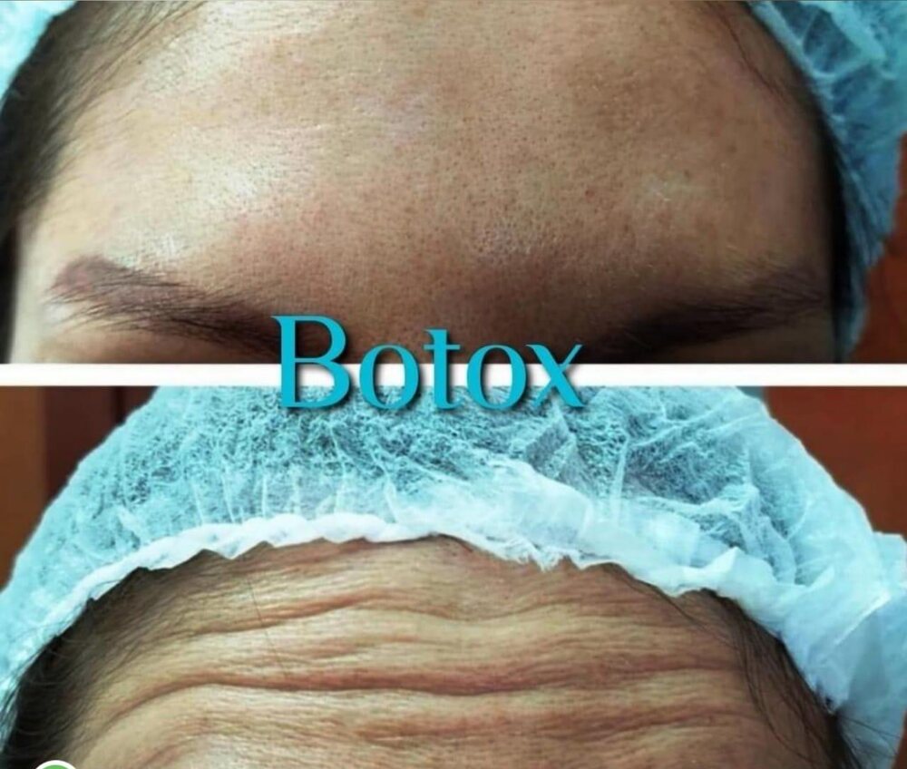 Antes y después de toxina botulínica en frente