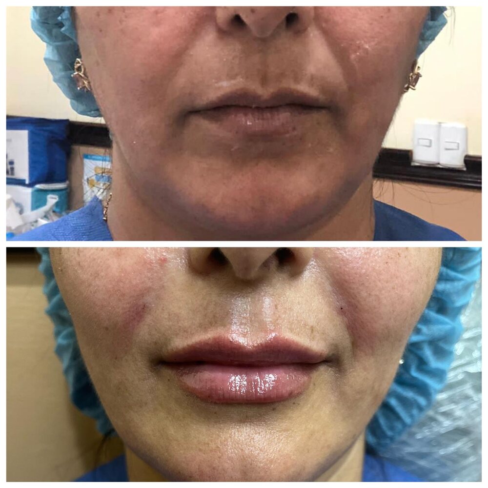 Antes y después de relleno de labios con ácido hialurónico