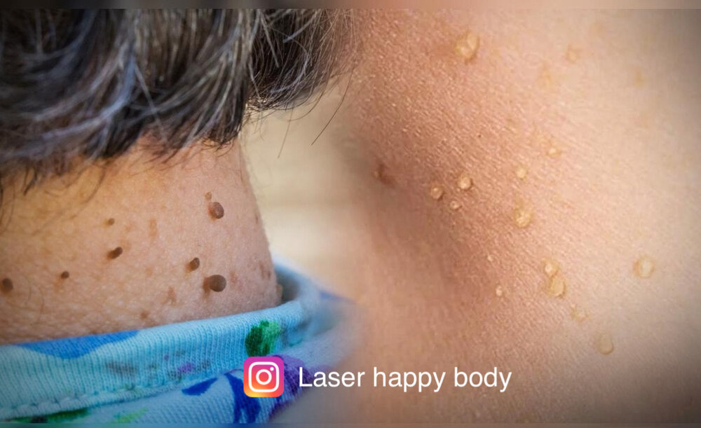 Antes y después de eliminación de acrocordones en el cuello
