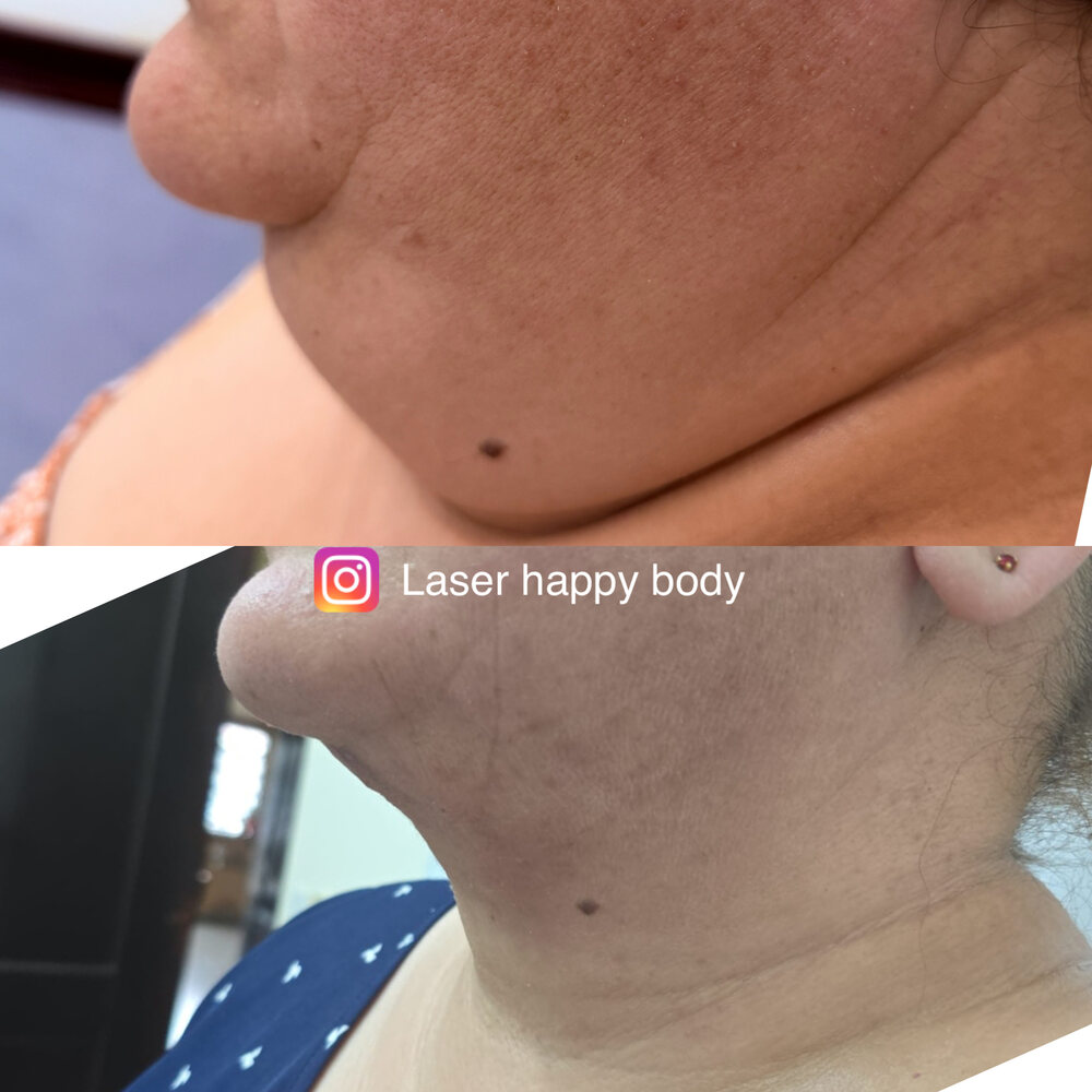 Antes y después de tratamiento de papada